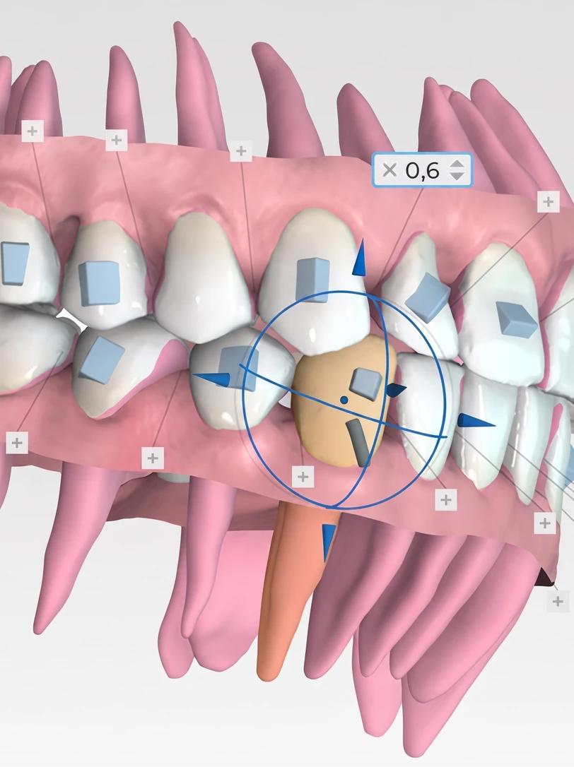 Digital treatment plan in 3D showing bracket placement and tooth movement